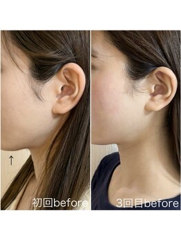 毛穴塾/話題の小顔マイクロリフト