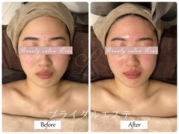 リノ(Lino)/ブライダルエステ♪