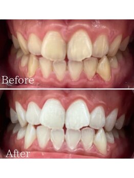 ホワイト 福岡天神店(WHITE)/６ヶ月継続ビフォーアフター