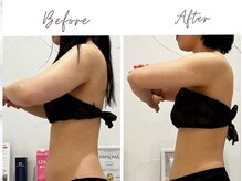 アモリール(Amolir)/痩身　ビフォーアフター