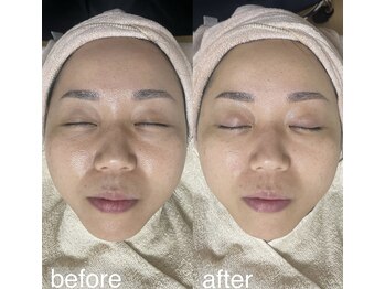 アルム(a'lm)/くすみ／クマ／開き毛穴／小顔