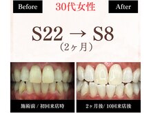 ホワイトニングセンター 長野駅前店/【長野市ホワイトニング】