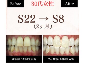 ホワイトニングセンター 長野駅前店/【長野市ホワイトニング】