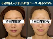 キュープ 表参道店(Qpu)/たった4回でここまで変わります