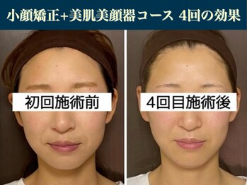 キュープ 表参道店(Qpu)/たった4回でここまで変わります