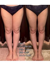 エステサロン 美飾り イオンモール木更津店/before⇒afteｒ/脂肪分解注入