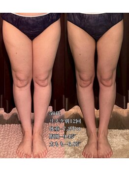 エステサロン 美飾り イオンモール木更津店/before⇒after/脂肪分解注入
