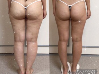 サロン ジョリー(Salon Jolie)/脚ヤせ！ヒップヤせ！！