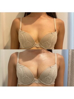 美人バスト 浦和店/【バストアップ★育乳】症例