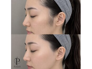 PODO KYOTO【シュガーリングワックス×光脱毛】の写真/【お顔のシュガーリングワックス】ごわつき、小鼻の黒ずみから解放されトーンアップ!メイクノリ◎