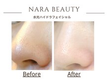ナラビューティー(NARA BEAUTY)/水光ハイドラフェイシャル