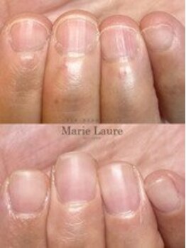 マリーロール 梅田店(Marie Laure)/自爪育成/深爪矯正/ネイルケア