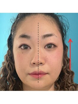 ネクスフィット(Nexfit)/小顔矯正フェイスリフトの効果