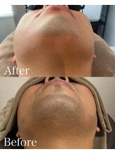 ミーエイト(Mii∞)/《ヒゲBefore/After》