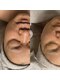 インディバサロン カルム(Calm.)の写真/インディバ小顔フェイシャル60分*ドライヘッドスパ付★オプションとの併用でたるみ/ほうれい線改善にも!!