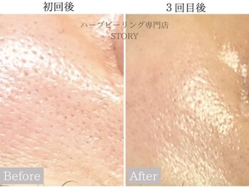ストーリー 岐阜店(STORY)/ハーブピーリング専門店STORY