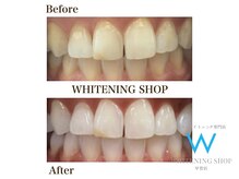 ホワイトニングショップ 甲賀店/Before&After『ホワイトニング』