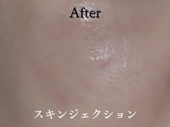 ダイヤモンド リーエンダ(Diamond leende)/スキンジェクション