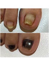 緒々 ワンプラス(one+)/痛くて切れなかった巻き爪が…