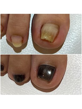 緒々 ワンプラス(one+)/痛くて切れなかった巻き爪が…