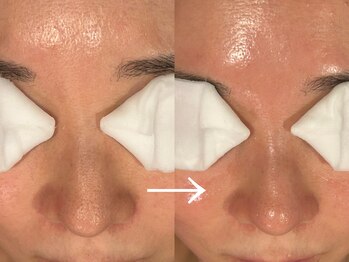 ビーフリー(Be free)/毛穴改善6回目