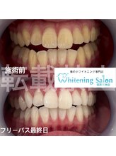 ホワイトニングサロン 福岡天神店/ホワイトニング