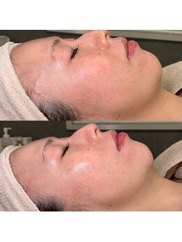 ジョイビー 新宿本店(JoyBee)/【エクソソーム導入】症例写真