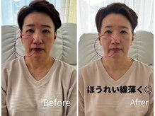 ミラ 中央林間(mira)/小顔 毛穴 ほうれい線 ハリ弾力