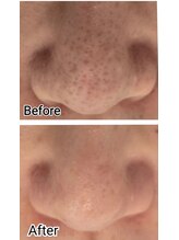 サロンド シェリー(Salon de Cherie)/気になる角栓・毛穴詰まりに。