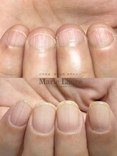 マリーロール 淀屋橋本店(Marie Laure)/自爪育成/深爪矯正/ネイルケア