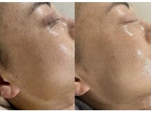 ラ クレール ビューティーサロン(LA CLAIR)/ホームケア×レチノールピール