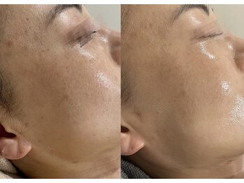 ラ クレール ビューティーサロン(LA CLAIR)/ホームケア×レチノールピール