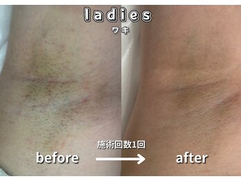 キュー(cue)/【レディース】「ワキ脱毛」