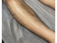 ワクシー 麻布十番店(WAXYYY.)/メンズ脚W脱毛