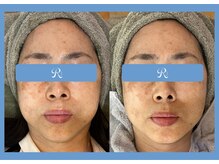 リスキン(Reskin)の雰囲気（当店1番人気!!ララピール×LDM 即効性◎）