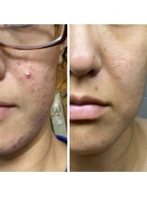 マリヴェリーテ(Mari verite)/ニキビ×毛穴詰まり【23回】