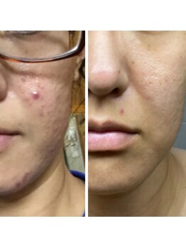 マリヴェリーテ(Mari verite)/ニキビ×毛穴詰まり【23回】