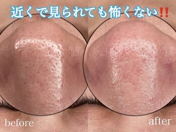 ビパール(bea pull)/ハーブピーリグ