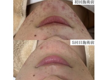 ルポ(RUPO)/繰り返すニキビ（20代）