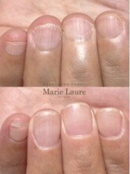 マリーロール 梅田店(Marie Laure)/自爪育成/深爪矯正/ネイルケア