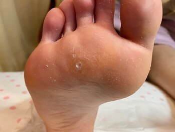 ビサンテ サロン/高プロのタコの中の魚の目ケア-5