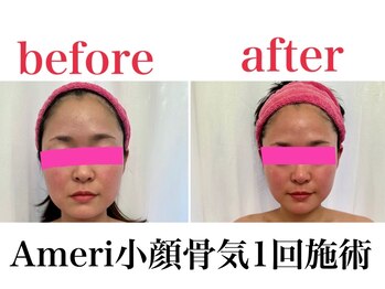 小顔矯正 アメリ ビューティーサロン(Ameri beauty salon)/韓国式コルギ小顔コース