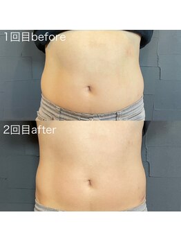 ビトタン 倉敷本店(+美to鍛)/レモンボトル（2回）