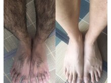 キミドリ(KIMIDORI)/メンズ脱毛