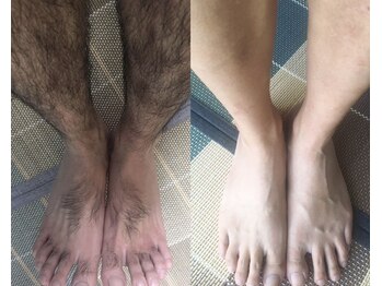 キミドリ(KIMIDORI)/メンズ脱毛