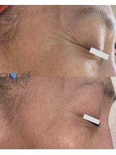 リベルテ(Liberte)/プロセルセラピーズ／顔