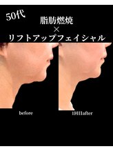 ノーブルノアール(Noble noir)/脂肪燃焼×リフトアップ