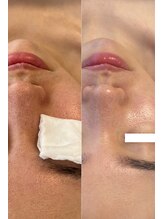 プリュボーテ 吉祥寺(Pul Beaute)/ ハーブピーリング