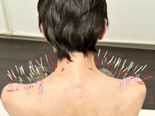 とだ鍼灸院/《うつむき姿勢◎》首肩こりに！