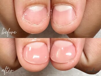 ツメハピ(tumehapi)/深爪ケア ビフォーアフター♪